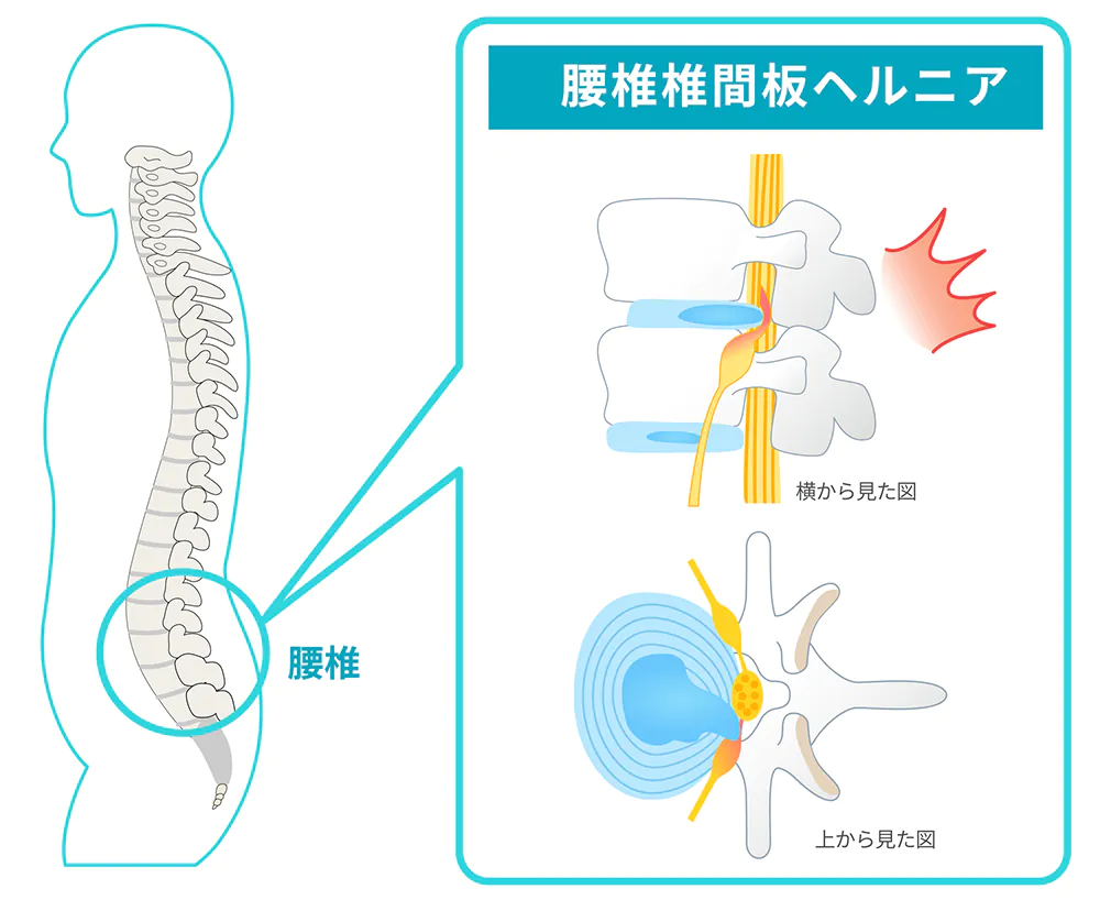 腰椎椎間板ヘルニアの原因は？