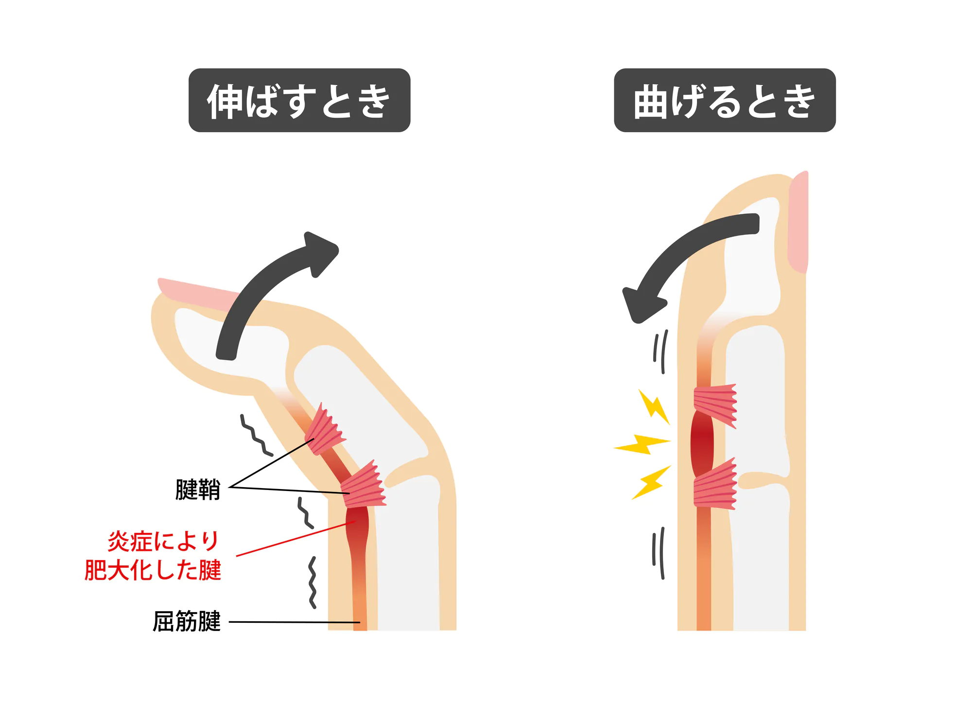 腱鞘炎（ばね指）