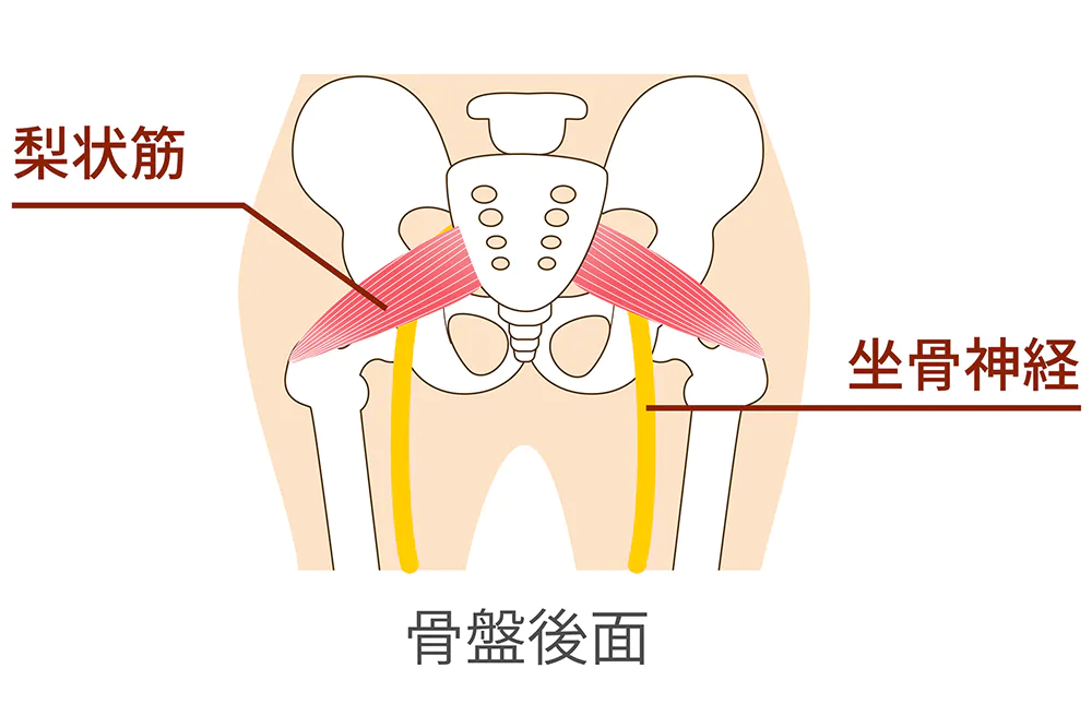 坐骨神経痛の原因は？
